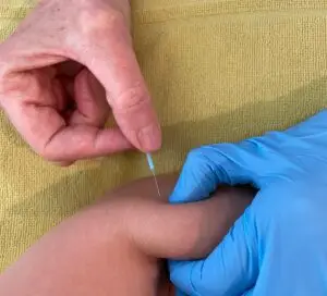 Dry Needling Therapie am Unterarm bei Muskelverspannungen – Medwell Thun