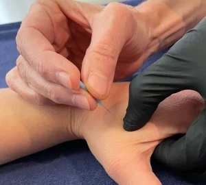 Dry Needling Behandlung am Adductor pollicis Daumen bei Medwell Thun